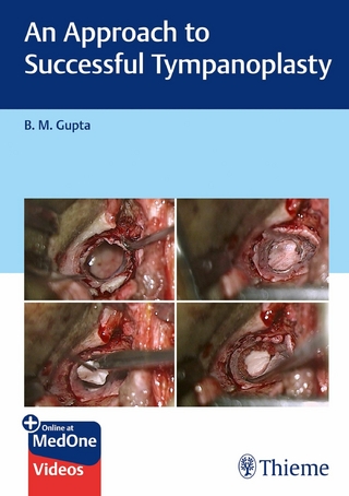 Approach to Successful Tympanoplasty