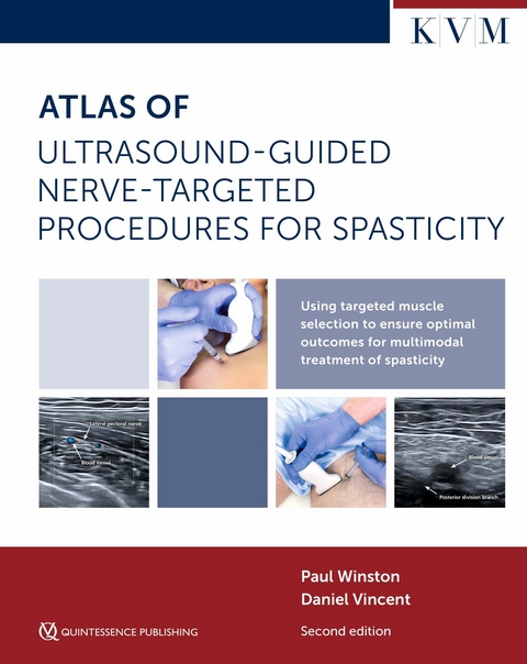Atlas of Ultrasound-Guided Nerve-Targeted Procedures for Spasticity -  Paul Winston,  Daniel Vincent