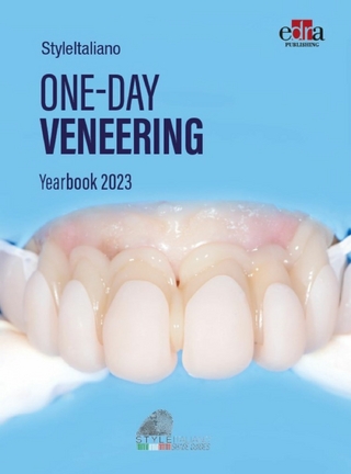One-day Veneering