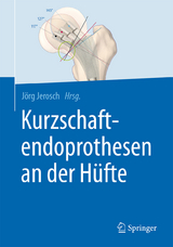 Kurzschaftendoprothesen an der H&uuml;fte - 