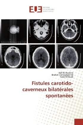Fistules carotido-caverneux bilat&eacute;rales spontan&eacute;es - Adil Belhachmi, Brahim Elmoustarchid, Gzaz Miloudi