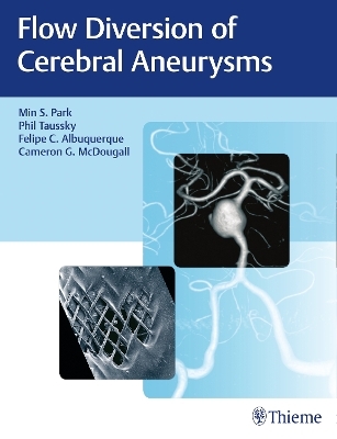 Flow Diversion of Cerebral Aneurysms - Min S. Park, Philipp Taussky, Felipe C. Albuquerque, Cameron G. McDougall
