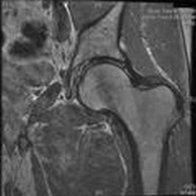 Femoral Neck Fractures Treatment - Kenneth J. Koval