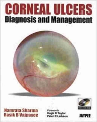 Corneal Ulcers Diagnosis and Management