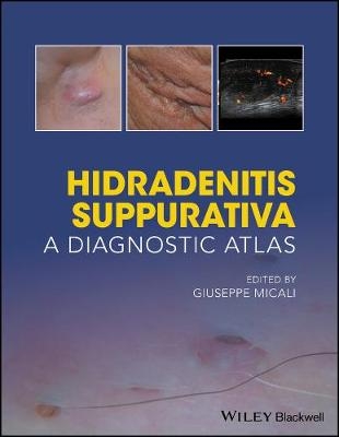 Hidradenitis Suppurativa &ndash; A Diagnostic Atlas - 