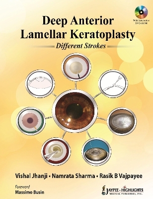 Deep Anterior Lamellar Keratoplasty Different Strokes