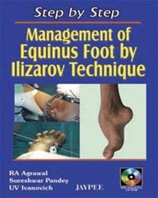 Step by Step: Management of Equinus Foot by Ilizarov Technique - RA Agrawal, S Pandey, UV Ivanovich