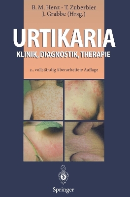 Urtikaria