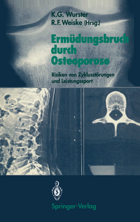 Erm&uuml;dungsbruch durch Osteoporose - 