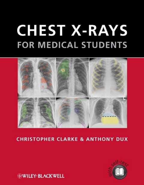 Chest X-rays for Medical Students - Christopher Clarke, Anthony Dux