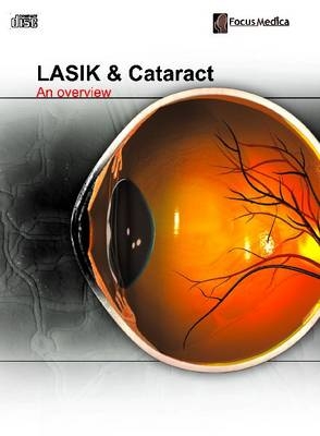 LASIK and Cataract - 