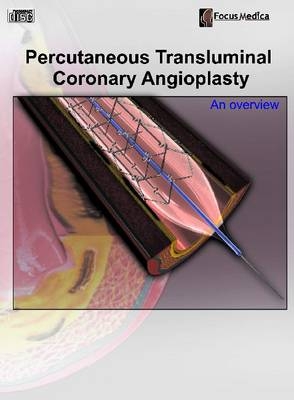Percutaneous Transluminal Coronary Angioplasty - 