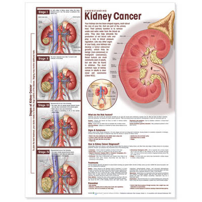 Understanding Kidney Cancer Anatomical Chart -  Anatomical Chart Company
