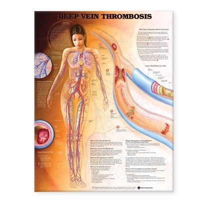 Deep Vein Thrombosis Anatomical Chart