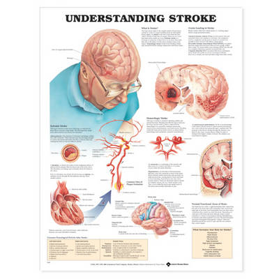 Understanding Stroke Anatomical Chart - 