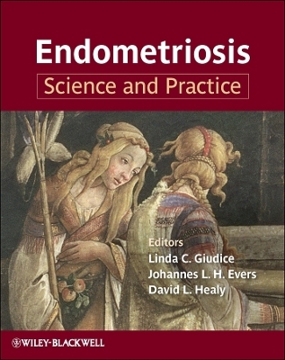 Endometriosis - 