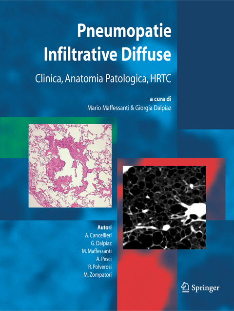 Pneumopatie Infiltrative Diffuse - 