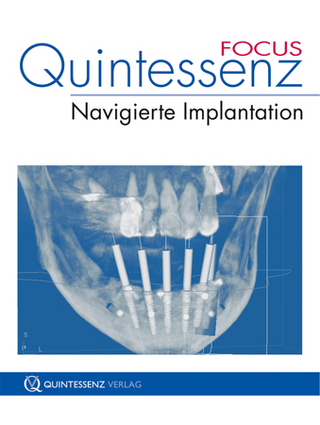 Quintessenz FOCUS Navigierte Implantation