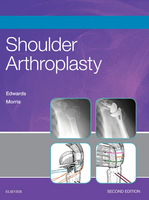 Shoulder Arthroplasty E-Book -  T. Bradley Edwards,  Brent J. Morris