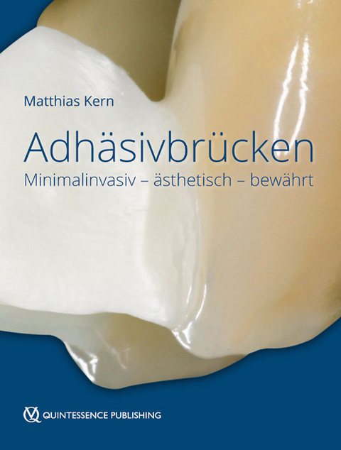 Adh&auml;sivbr&uuml;cken - Matthias Kern