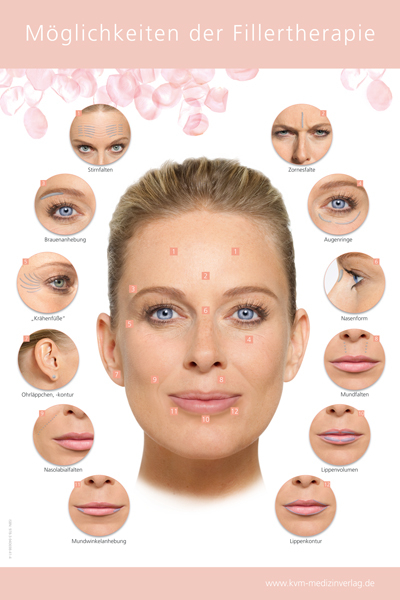 Poster &ndash; M&ouml;glichkeiten der Fillertherapie