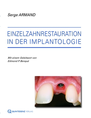 Einzelzahnrestauration in der Implantologie