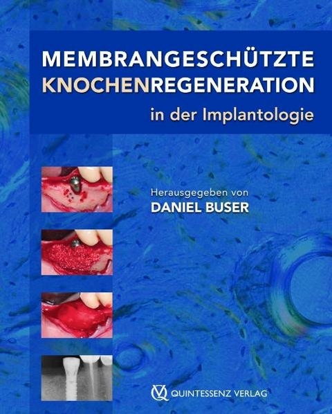 Membrangesch&uuml;tzte Knochenregeneration in der Implantologie - 
