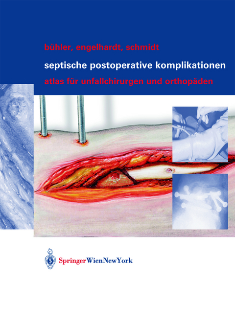 Septische postoperative Komplikationen - Matthias B&uuml;hler, Martin Engelhardt, Hergo G.K. Schmidt