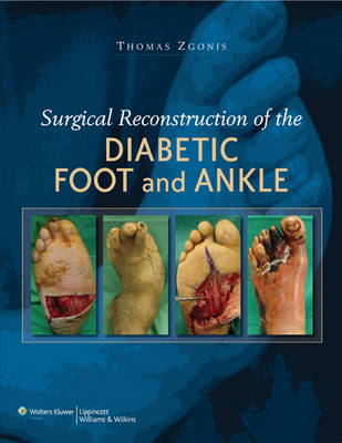 Surgical Reconstruction of the Diabetic Foot and Ankle