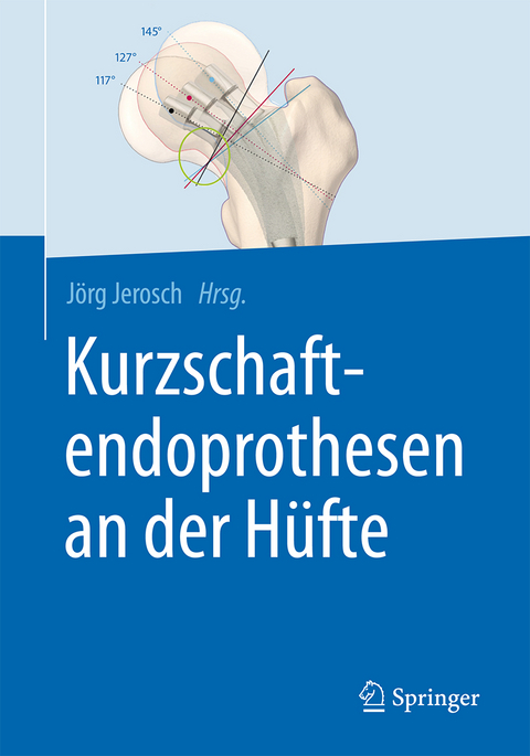 Kurzschaftendoprothesen an der H&uuml;fte - 