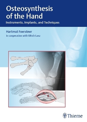 Osteosynthesis of the Hand - Hartmut F&ouml;rstner