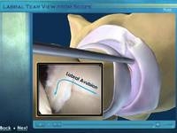 Hip Arthroscopy