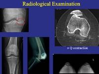 Adult Reconstruction Knee