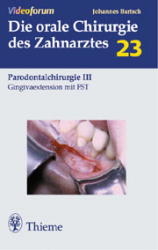Gingivaextension mit FST