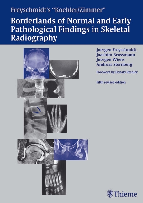 Freyschmidt's "Koehler/Zimmer" Borderlands of Normal and Early Pathological Findings in Skeletal Radiography - J&uuml;rgen Freyschmidt, Joachim Brossmann, J&uuml;rgen Wiens, Andreas Sternberg