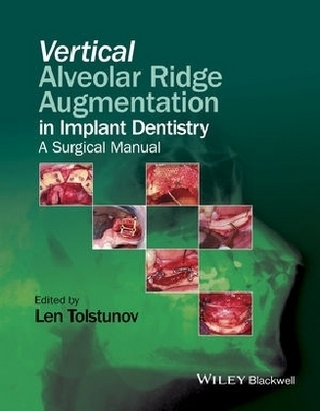 Vertical Alveolar Ridge Augmentation in Implant Dentistry
