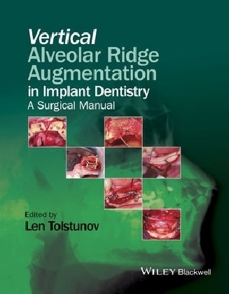 Vertical Alveolar Ridge Augmentation in Implant Dentistry - 
