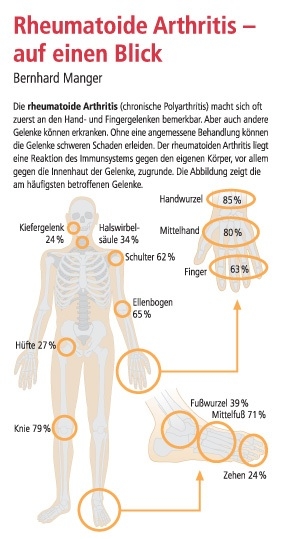 Rheumatoide Arthritis - auf einen Blick