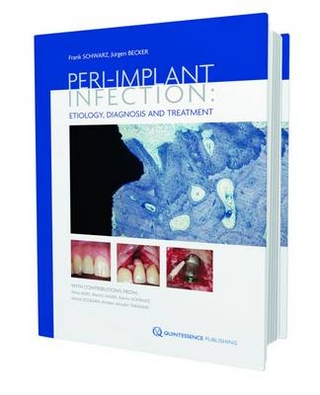 Peri-Implant Infection Etiology