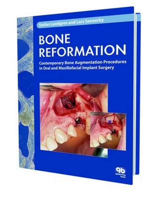 Bone Reformation