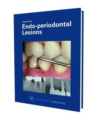 Endo-periodontal Lesion - Edoardo Foce