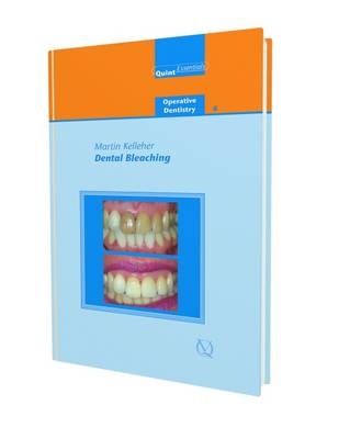 Dental Bleaching - Martin Kelleher