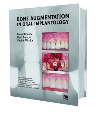 Bone Augmentation in Oral Implantology - Fouad Khoury, Hadi Antoun, Patrick Missika