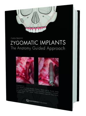 Zygomatic Implant - Carlos Aparicio