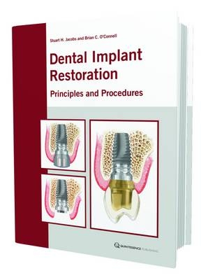 The Restoration of Dental Implants with Fixed Prosthesis