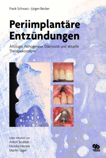 Periimplant&auml;re Entz&uuml;ndungen - Frank Schwarz, J&uuml;rgen Becker