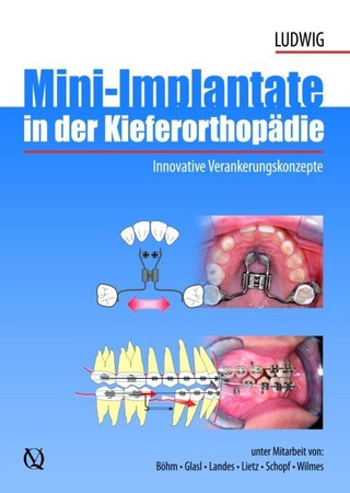 Mini-Implantate in der Kieferorthopädie