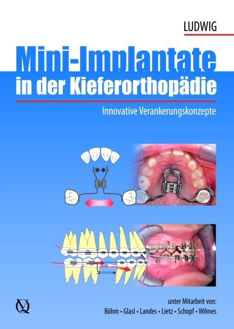 Mini-Implantate in der Kieferorthop&auml;die - Bj&ouml;rn Ludwig