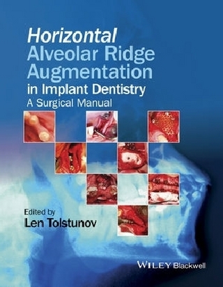 Horizontal Alveolar Ridge Augmentation in Implant Dentistry