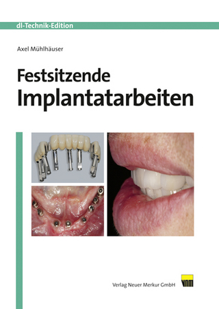 Festsitzende Implantatarbeiten